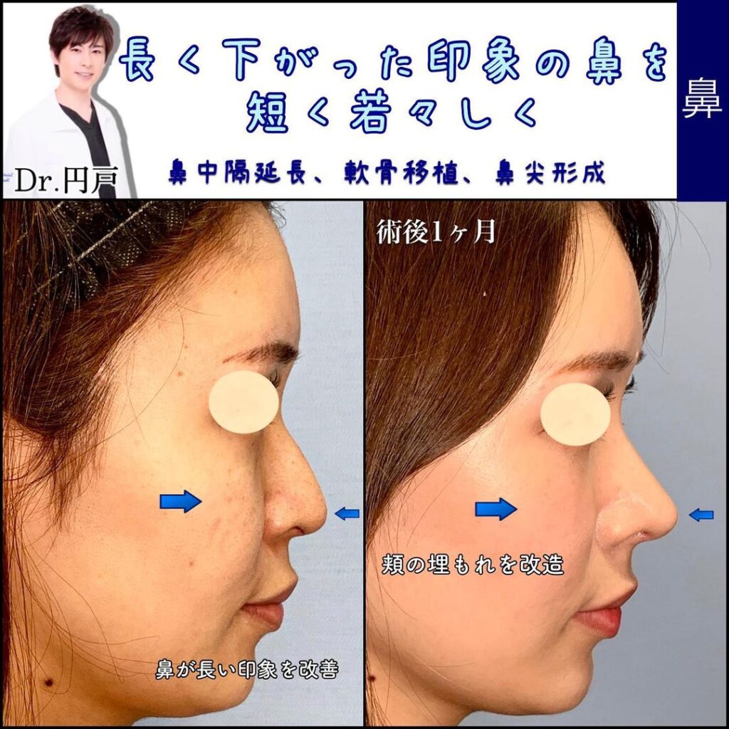 保存軟骨を使用した鼻の整形の症例 (1)