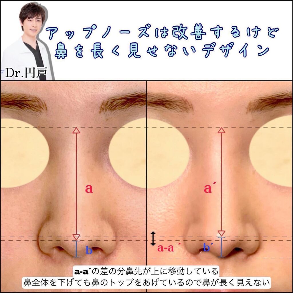 鼻中隔延長のデザインの図解