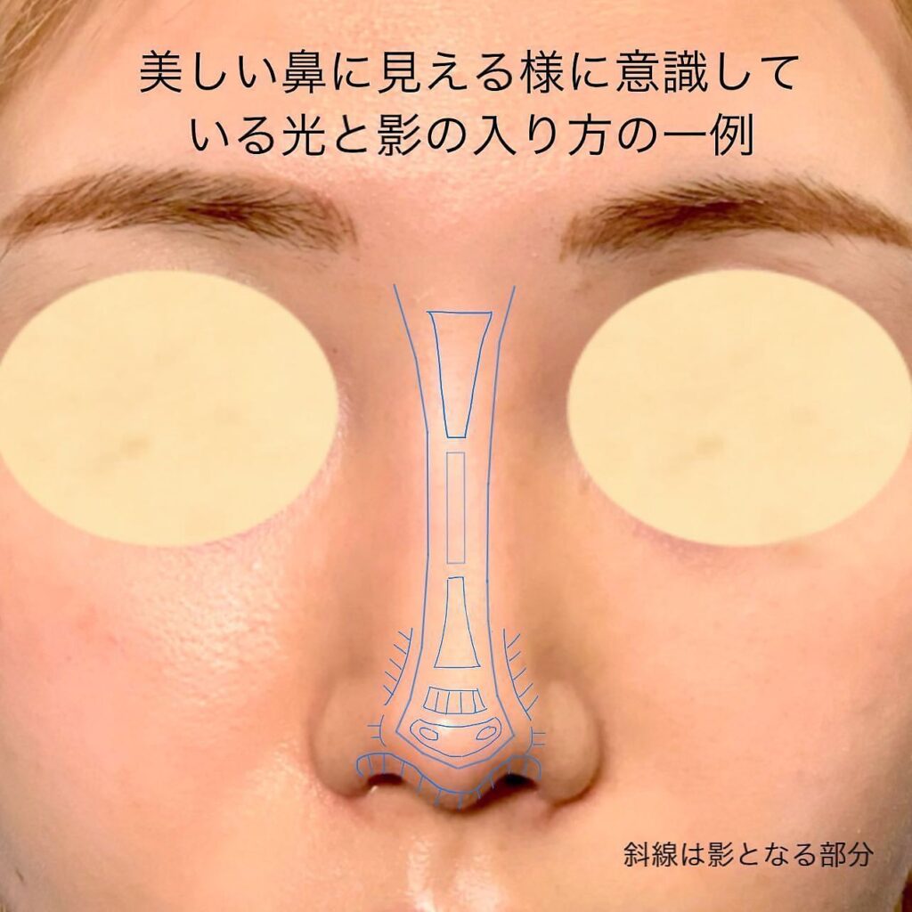 鼻中隔延長のデザイン