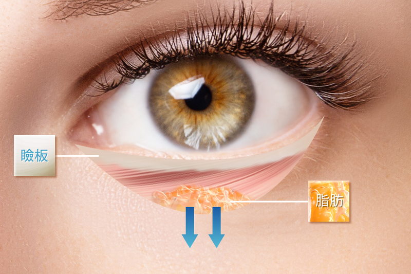 眼窩脂肪と瞼板の説明