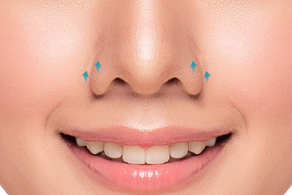 鼻孔縁挙上術の症例写真のイメージ