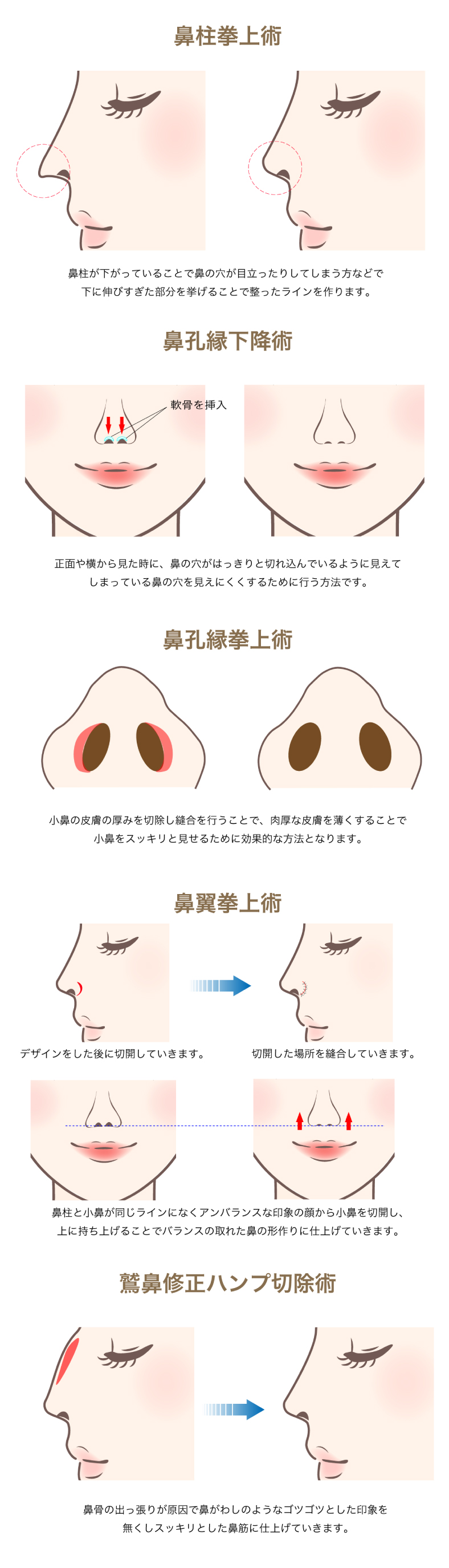 鼻の手術について