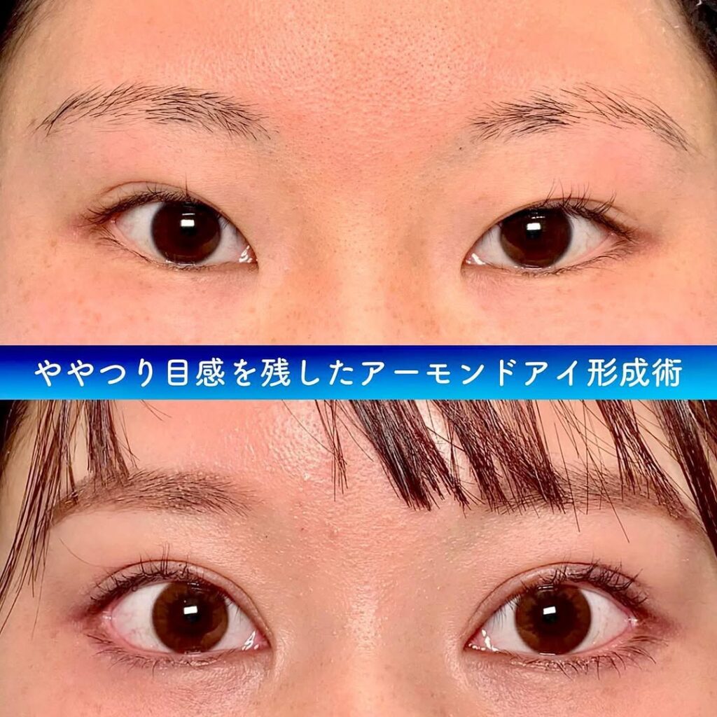 アーモンドアイの症例写真