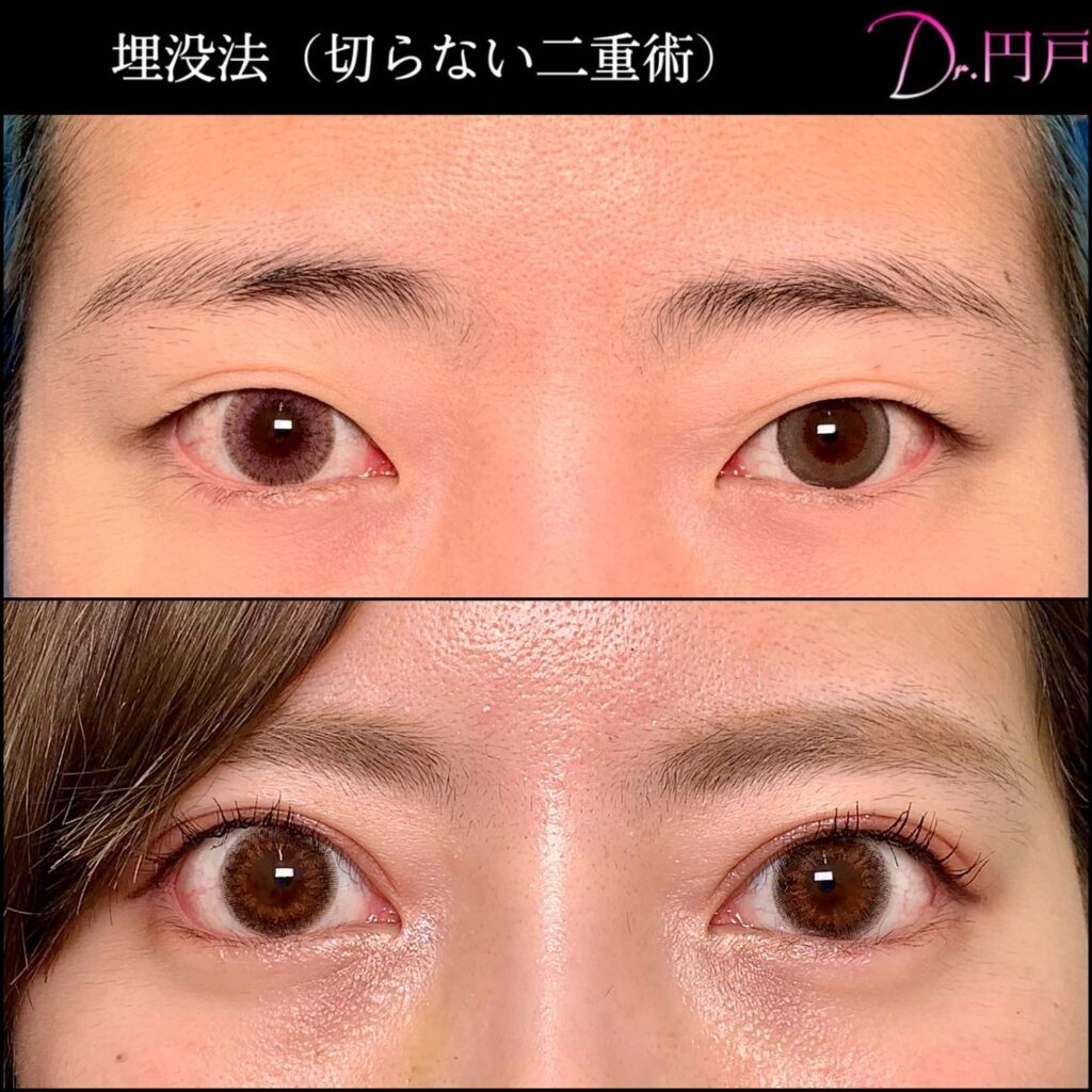 二重埋没法 上手い先生 名医