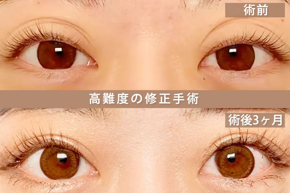 眼瞼下垂の他院の失敗の修正手術の症例
