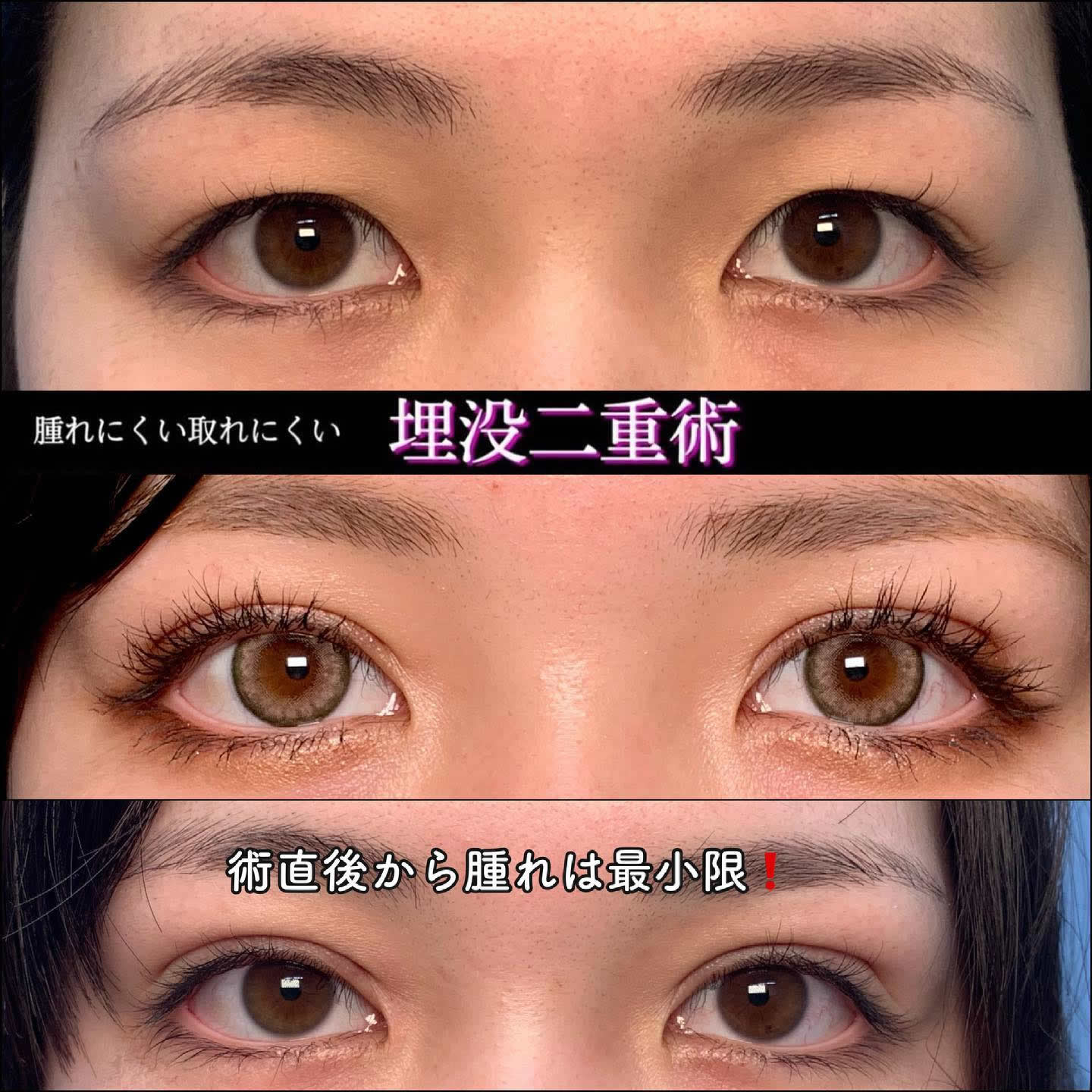 埋没法を受けた20代女性