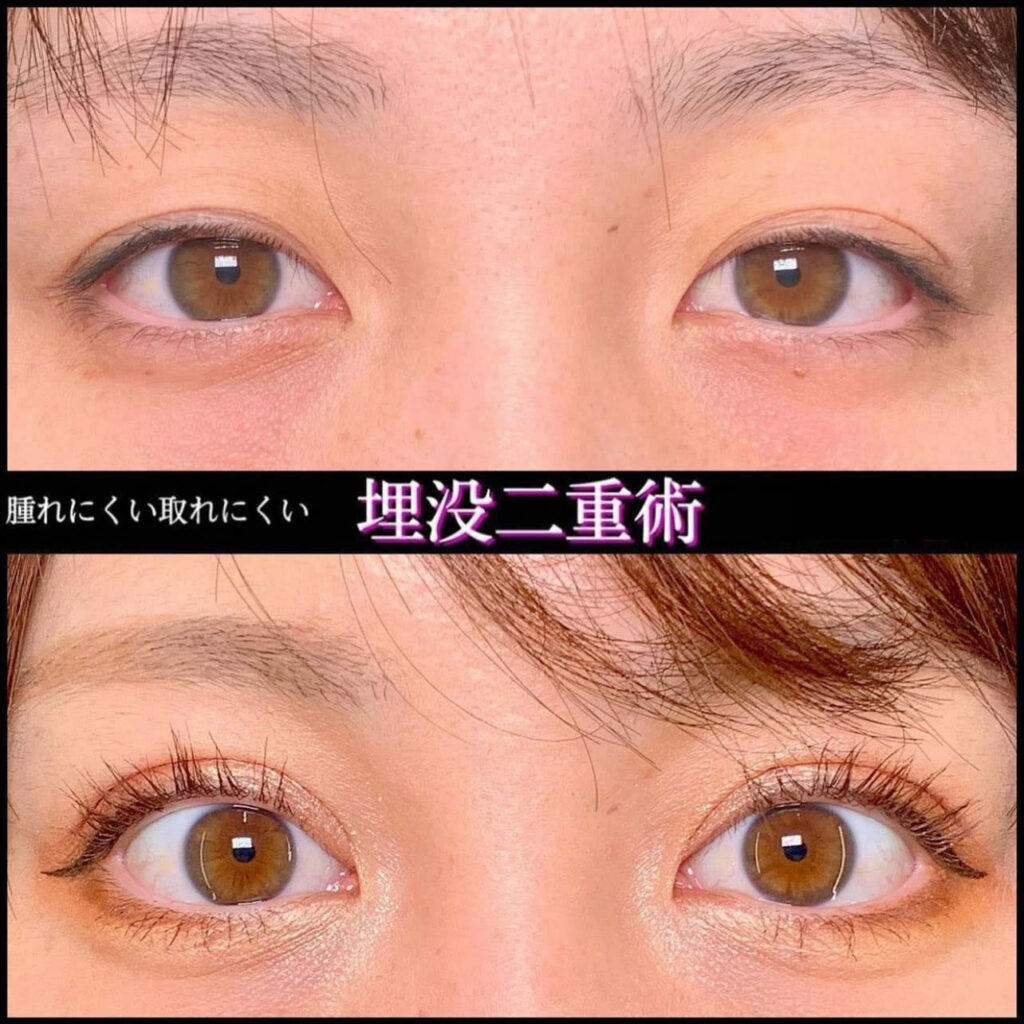 二重埋没法 上手い先生 名医