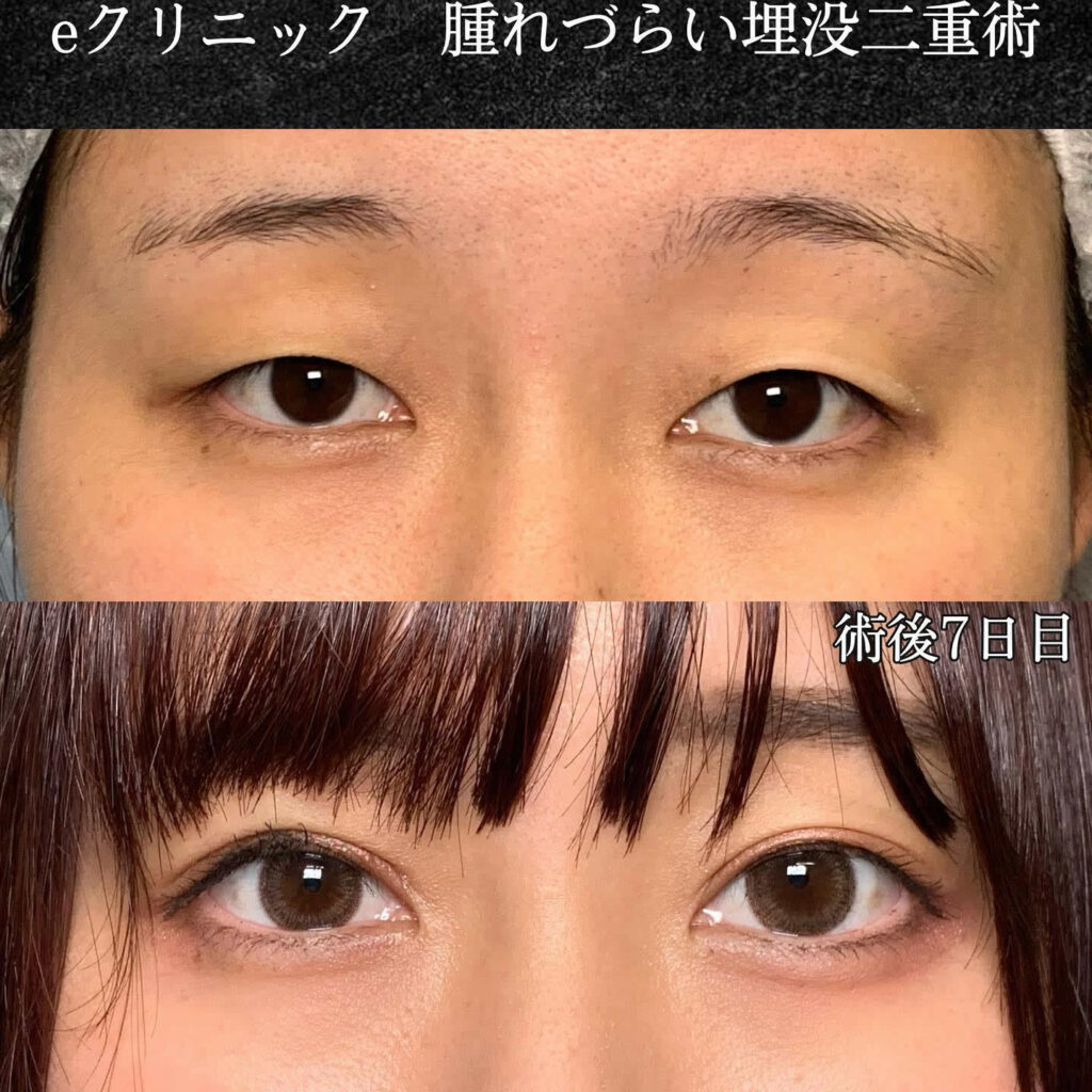 二重埋没 上手い先生 名医