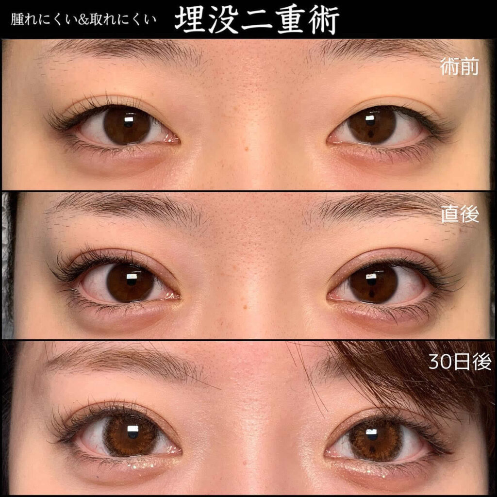 二重埋没 上手い先生 名医