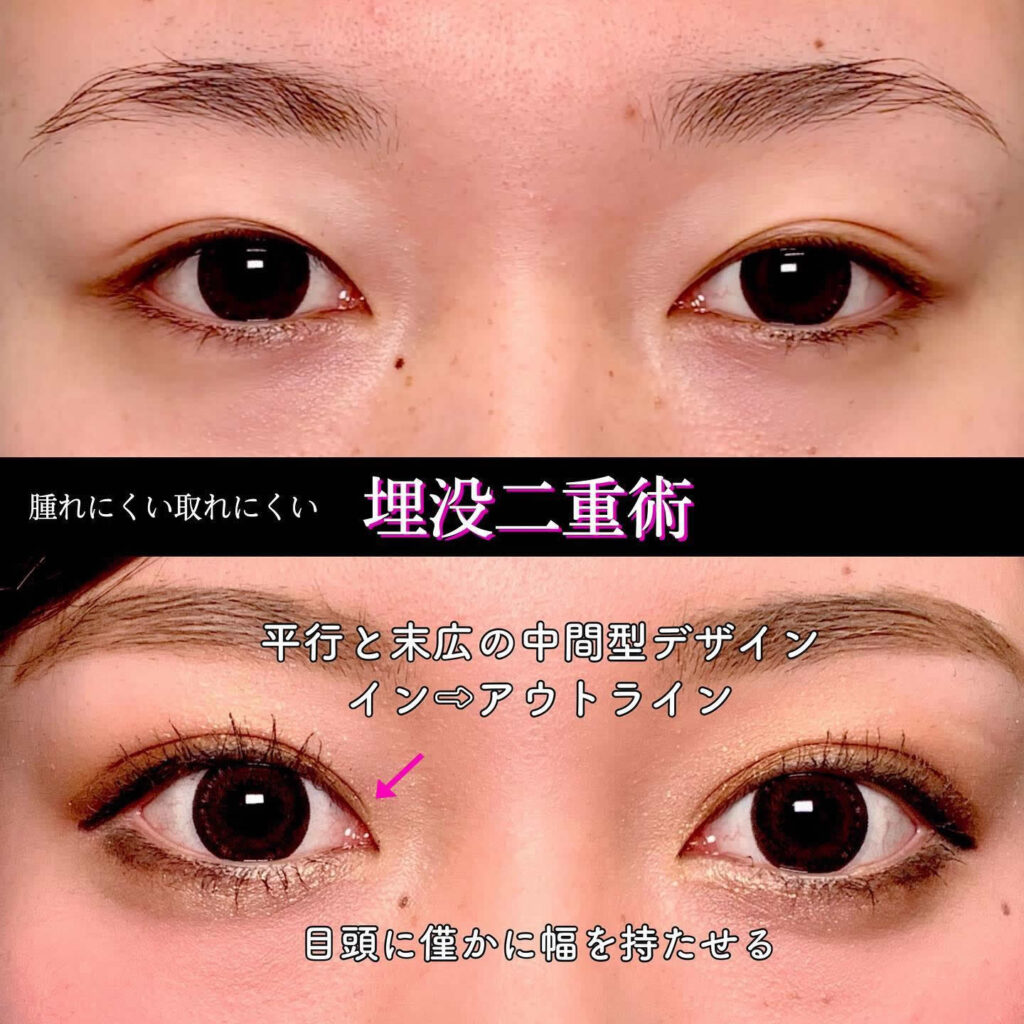 二重埋没 上手い先生 名医