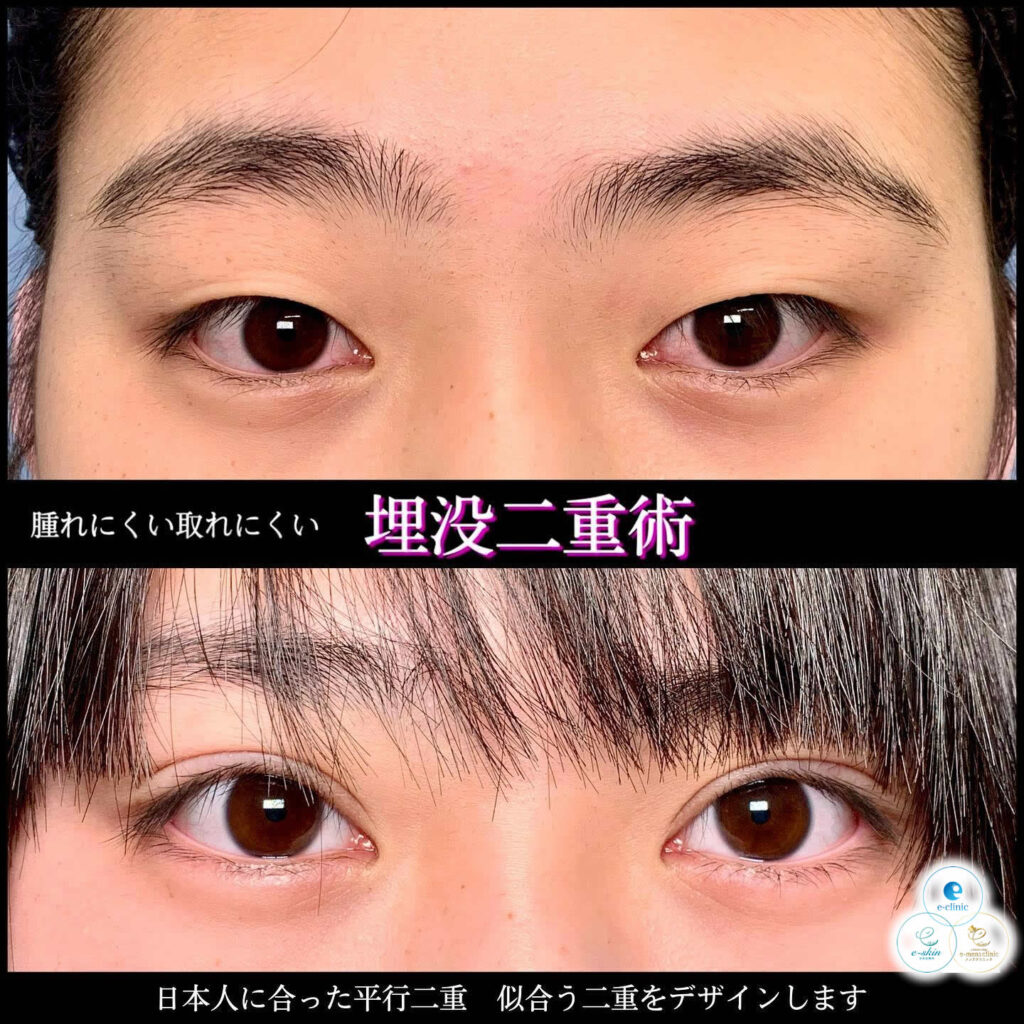 二重埋没 上手い先生 名医