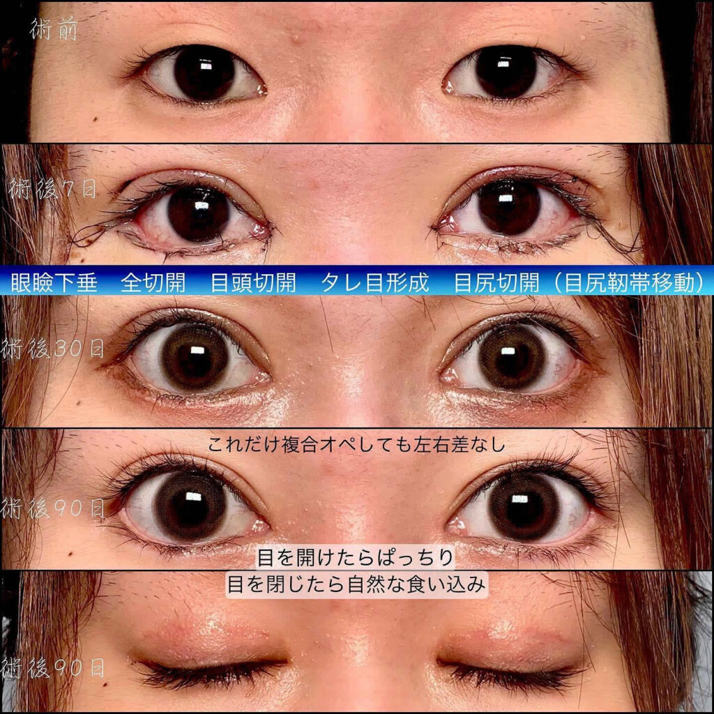 眼瞼下垂の術後の経過