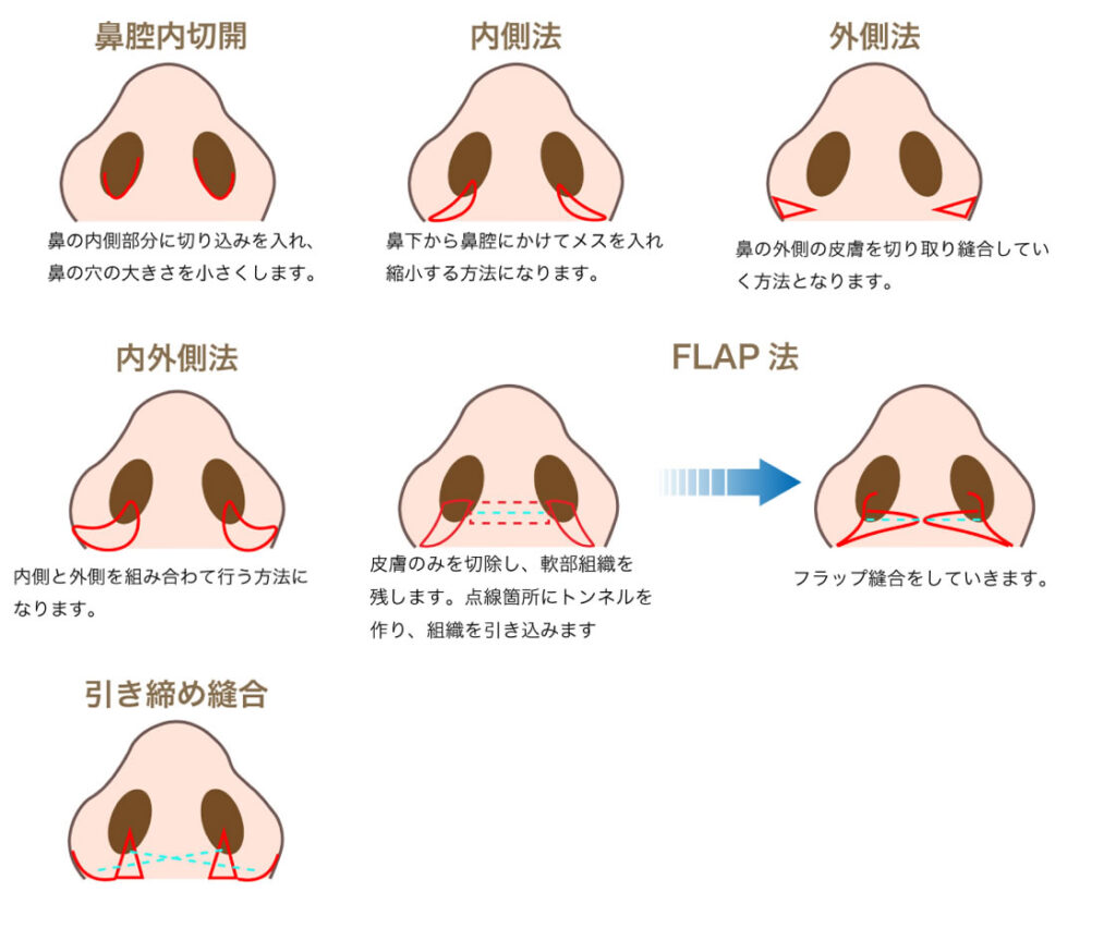 男性にもおすすめの小鼻縮小を詳しく解説|金沢の美容外科・美容整形はeクリニック
