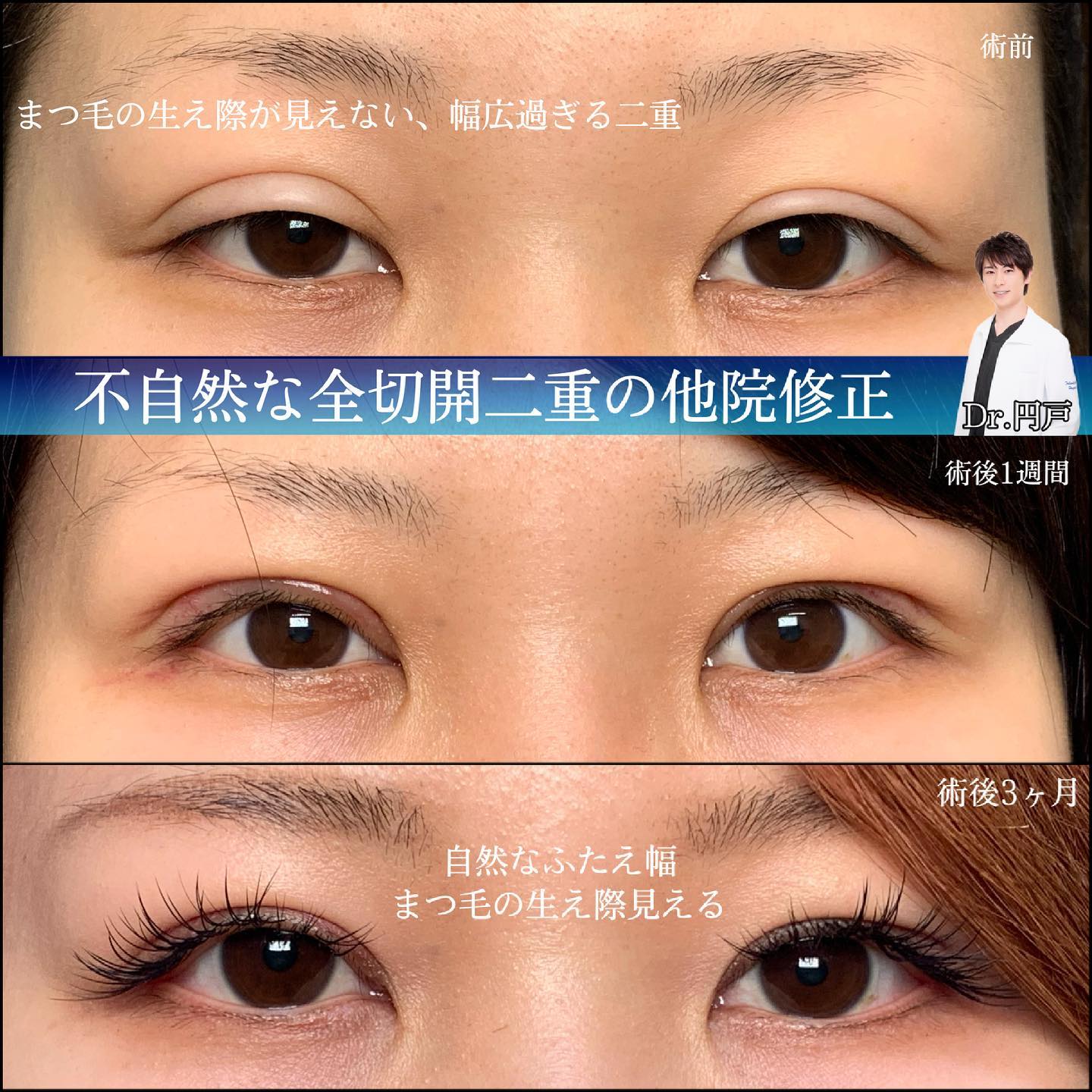 不自然な全切開の他院修正の症例