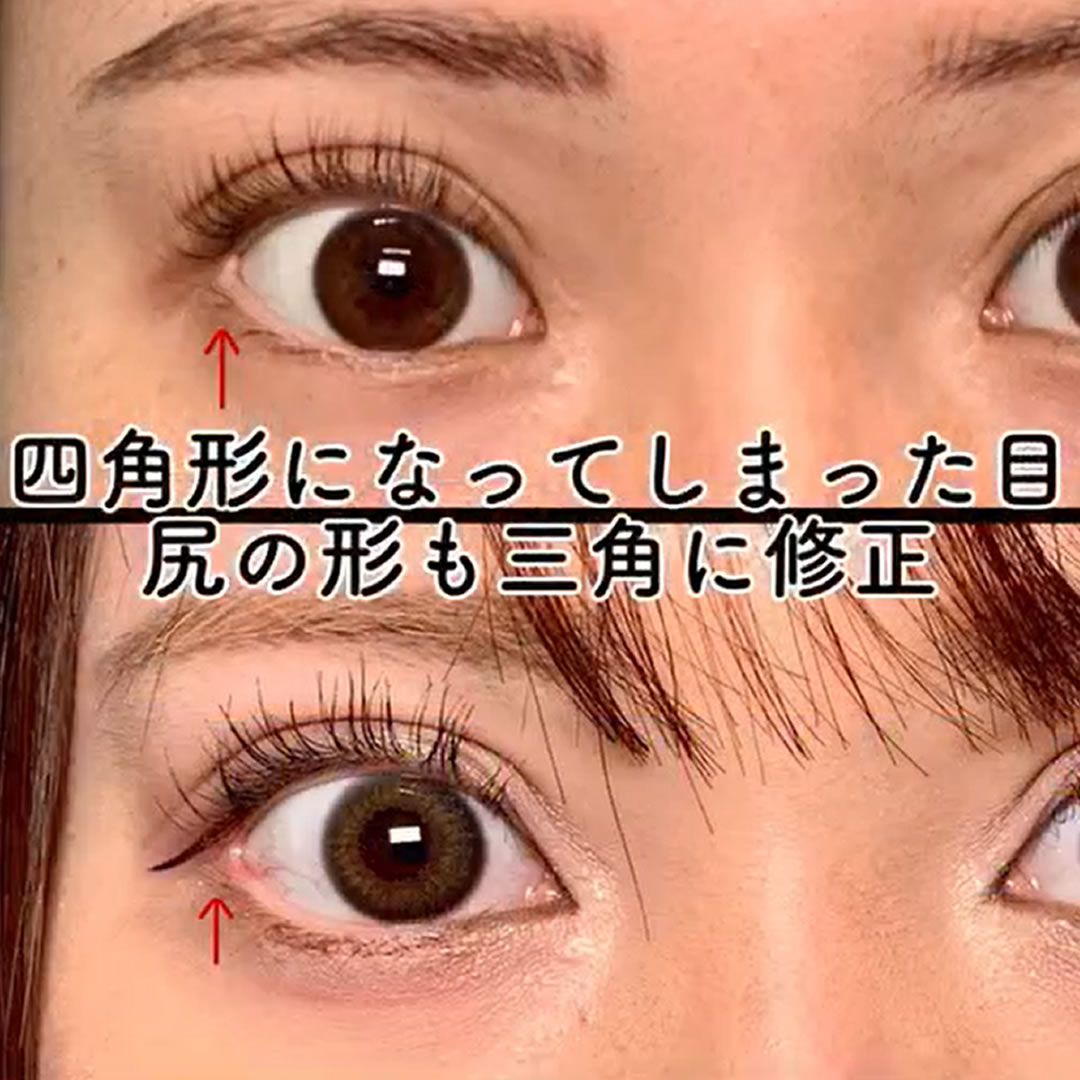 目尻切開で四角形になった目尻を三角形にした症例