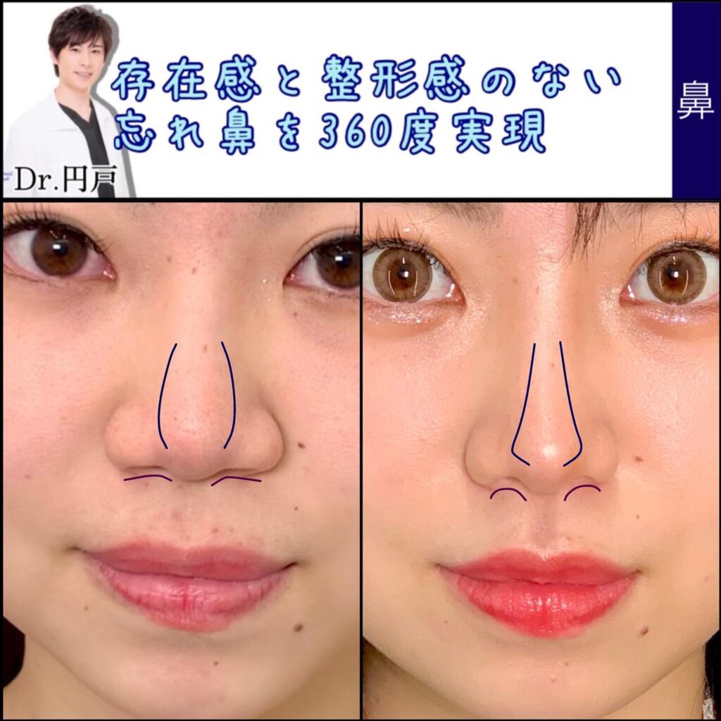 鼻の耳の軟骨移植の症例 (1)