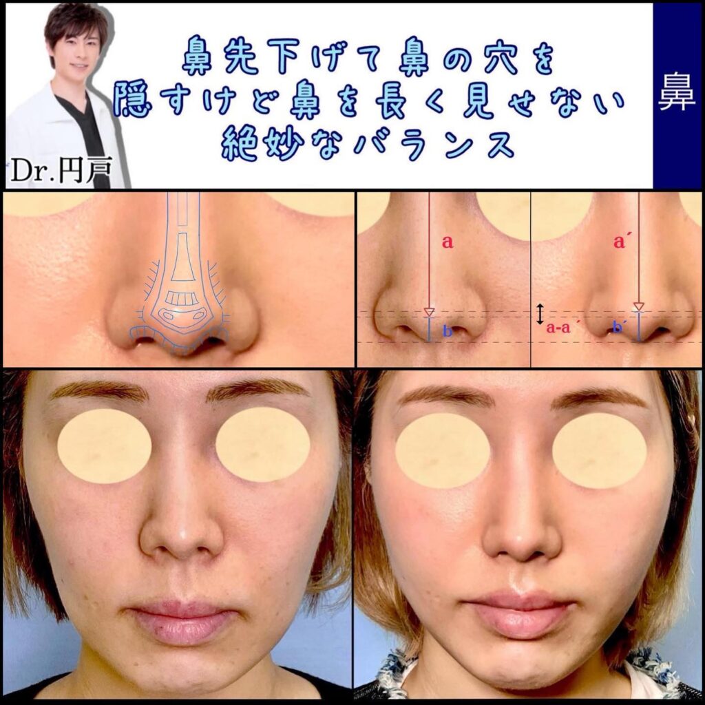 鼻中隔延長の症例 (5)