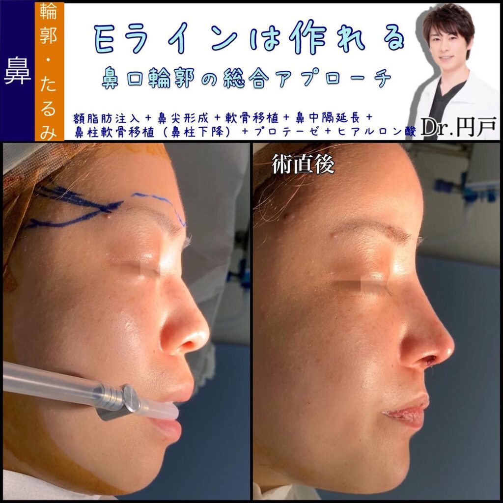 鼻柱下降と鼻尖形成と鼻中隔延長の術直後の症例