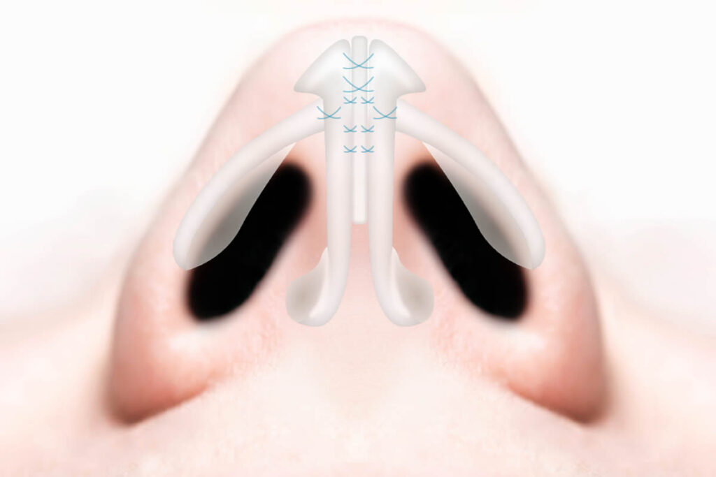 鼻尖形成３D法