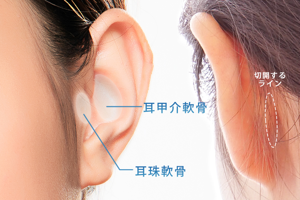 耳の軟骨を切開する位置の図解