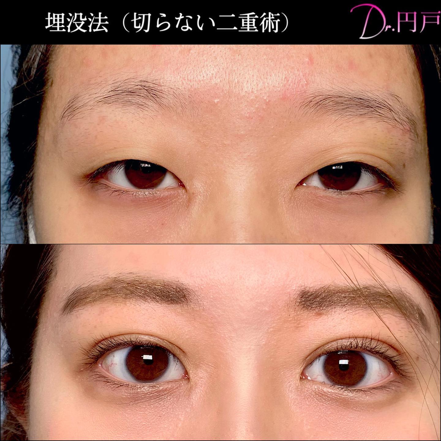 【目を大きくする方法】目は自力でどこまで大きくなるのか？｜金沢の美容外科・美容整形はeクリニック