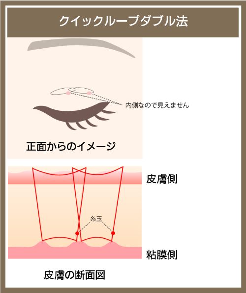 クイックループダブル法の図解.