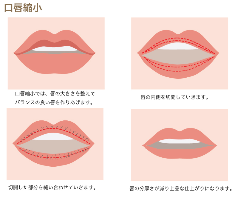 口唇縮小術の図解