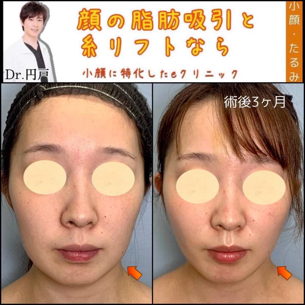 顔の脂肪吸引と糸リフトの症例写真