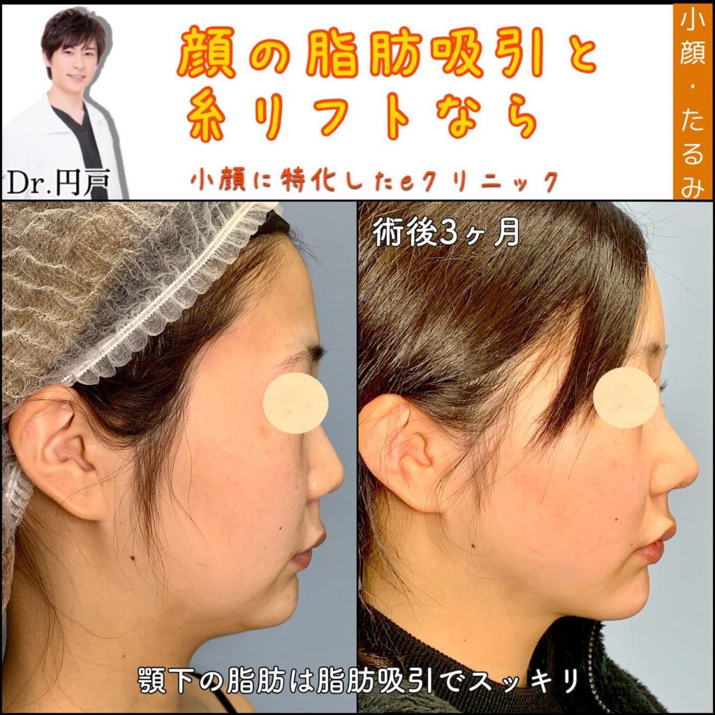 ほほあご脂肪吸引と糸リフトと鼻整形の術後3ヶ月の横顔の症例写真