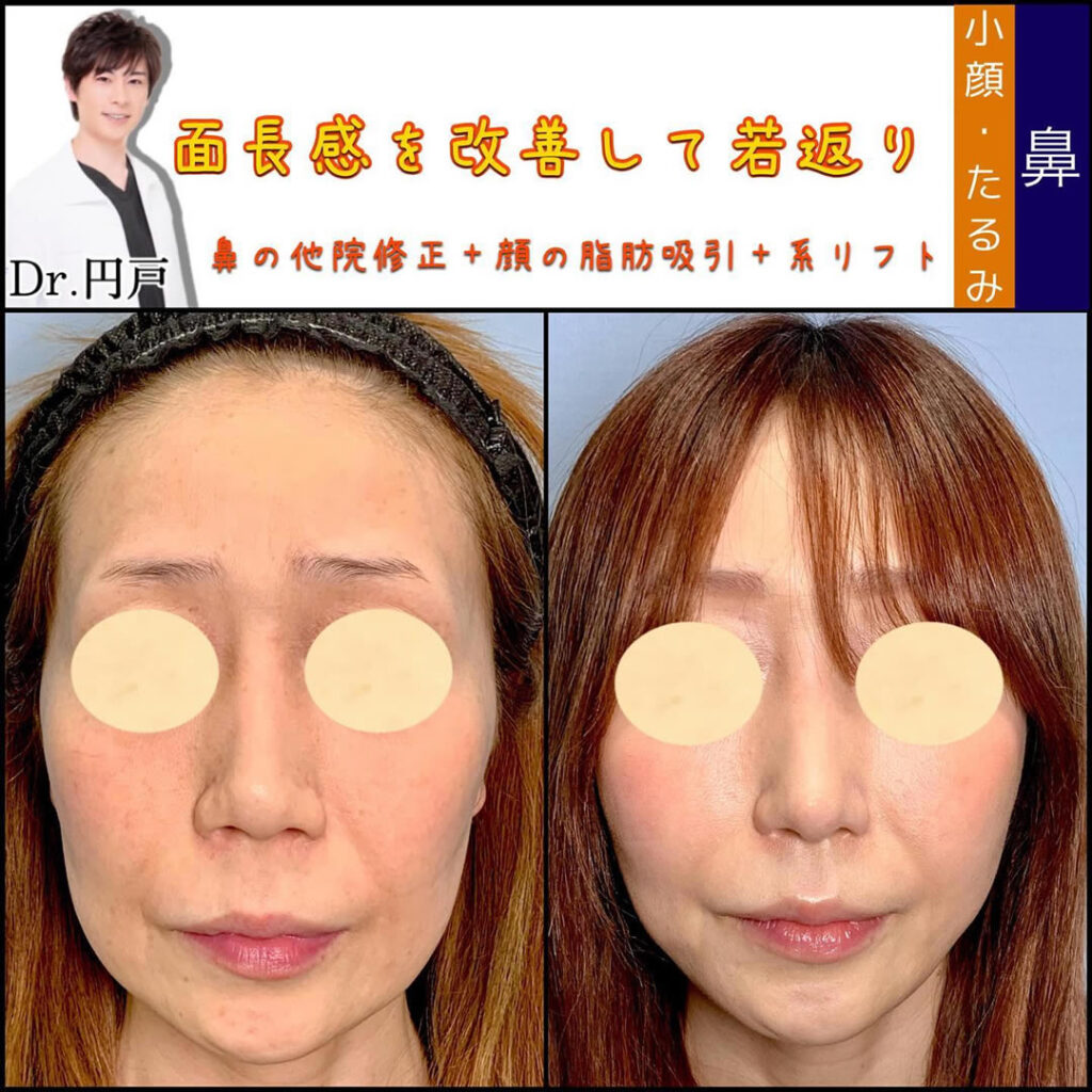 鼻の他院修正と顔の支部吸引と糸リフトを受けた女性の症例写真