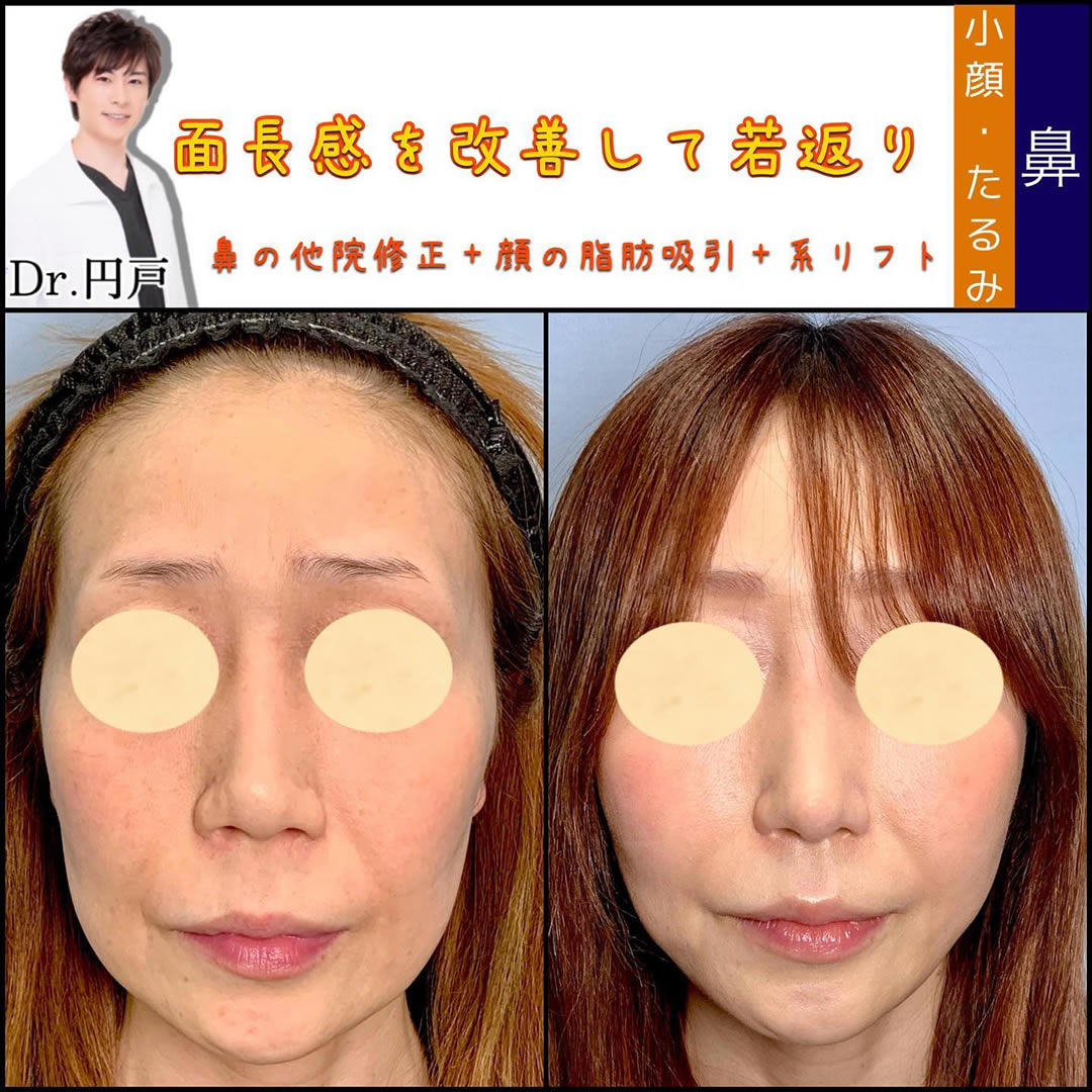 鼻の他院修正と顔の支部吸引と糸リフトを受けた女性の症例写真