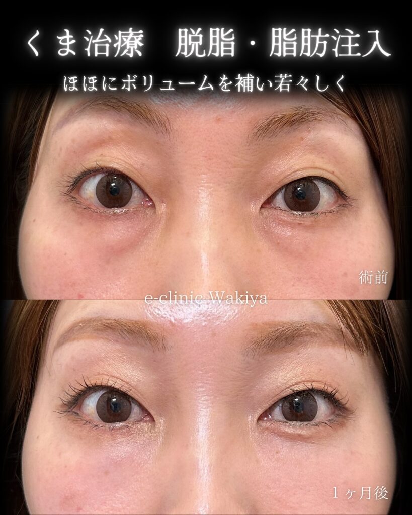 脇谷雄一朗医師 脱脂+脂肪注入 クマ取り