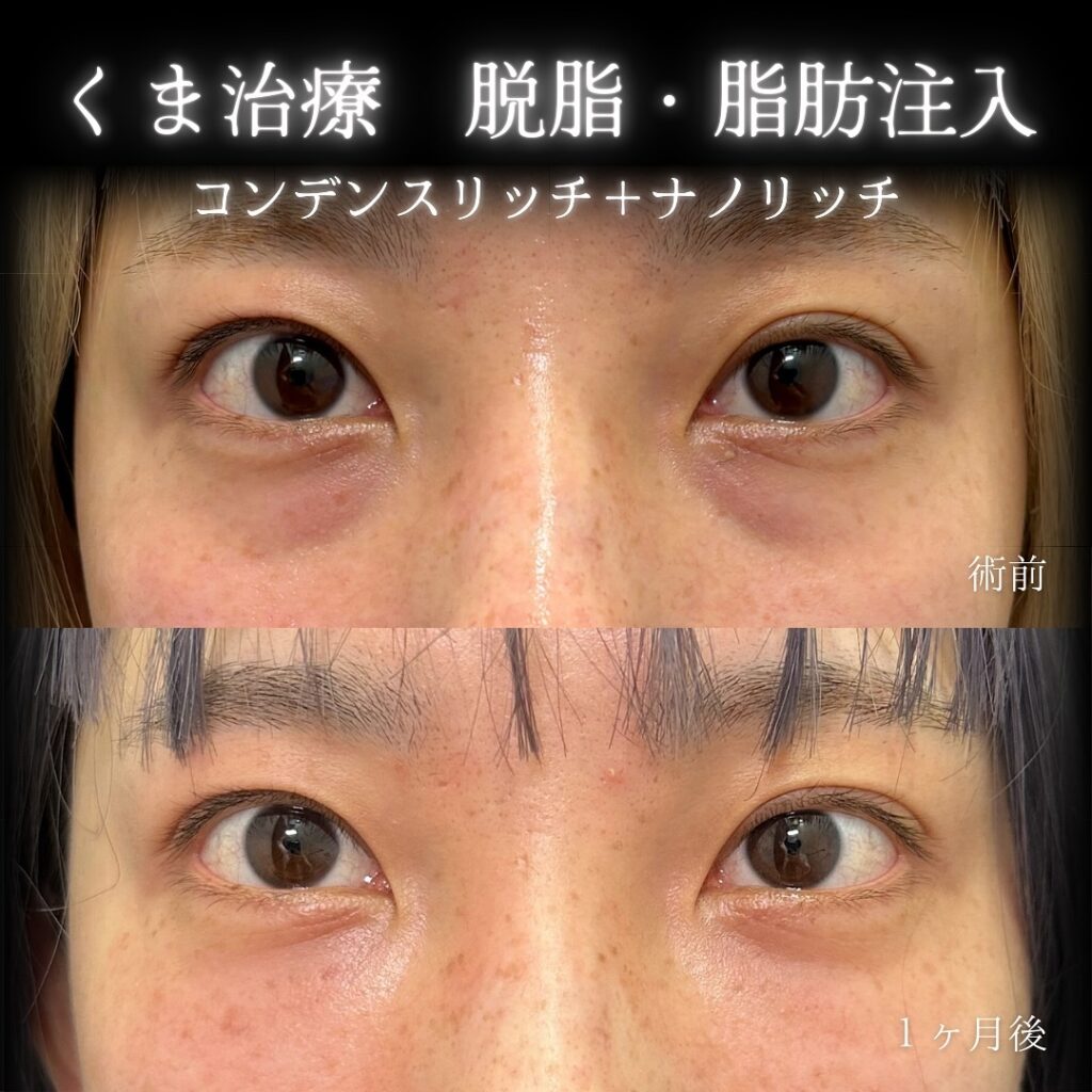 脇谷雄一朗医師 脱脂+脂肪注入 クマ取り