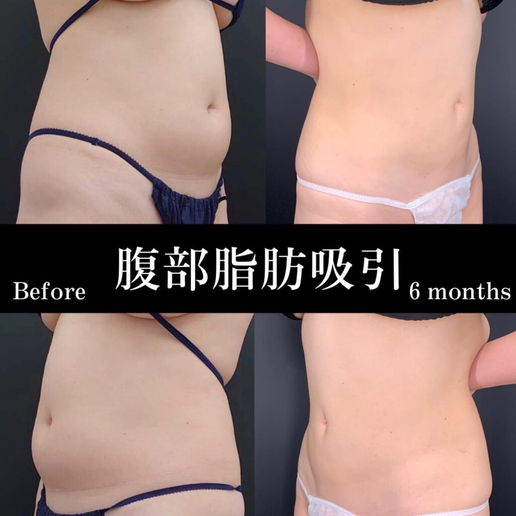 お腹の脂肪吸引の手術前と６か月後の症例写真