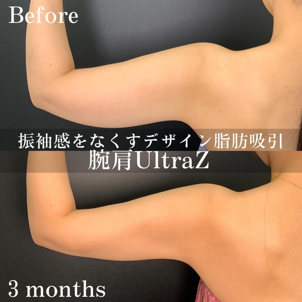 二の腕の脂肪吸引の手術前と3か月後の症例