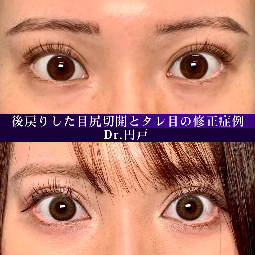 後戻りした目尻切開とタレ目の他院修正の症例写真