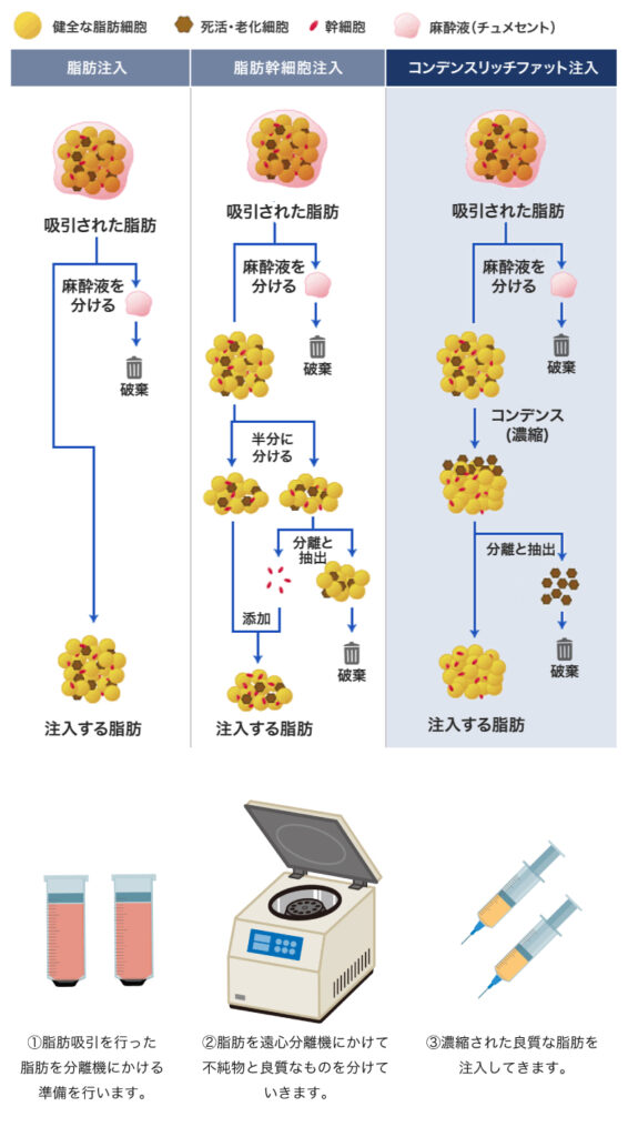 脂肪注入の豊尻の図解