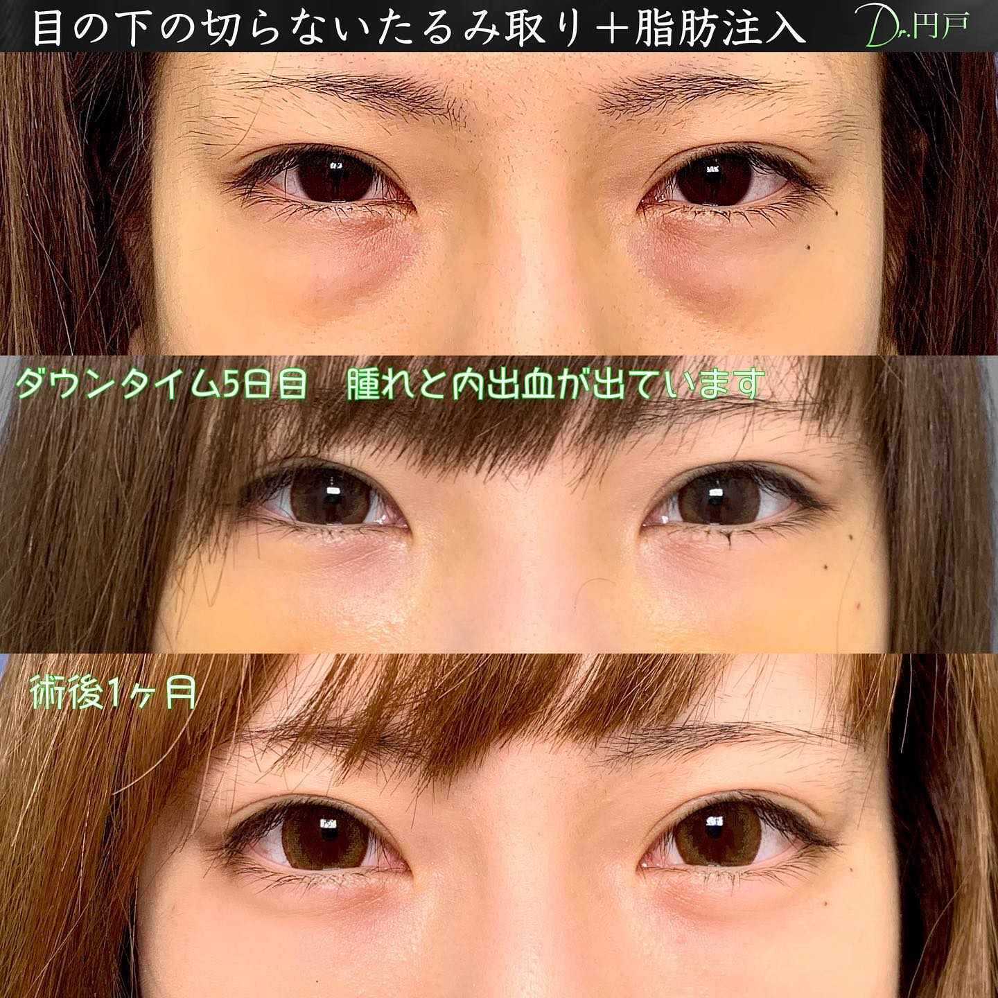 裏ハムラと脂肪注入の５日後と１か月後の症例写真