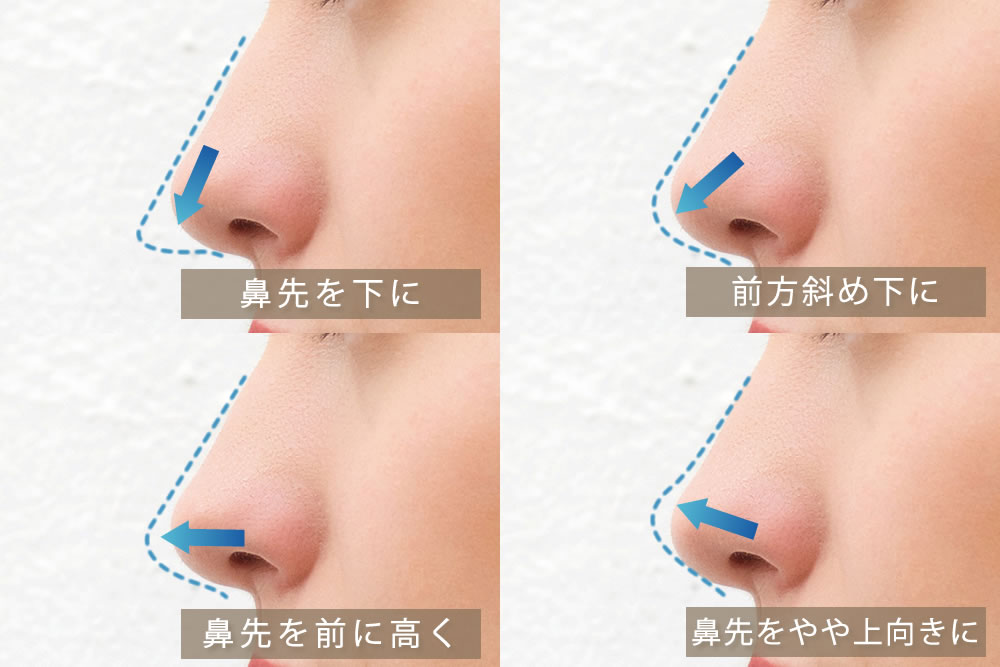 鼻中隔延長の結果のイメージ