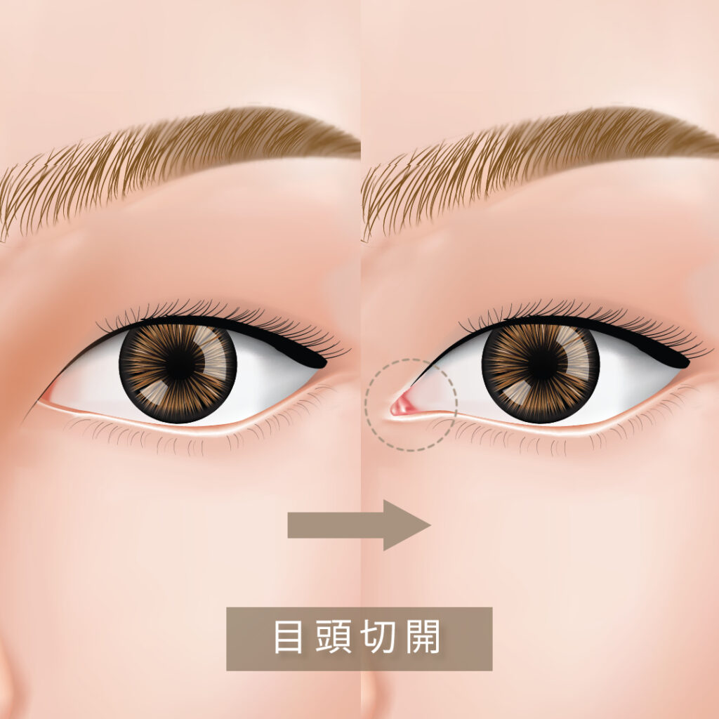目を大きくする整形には何がある？種類と向いている人をご紹介｜金沢の美容外科・美容整形はeクリニック