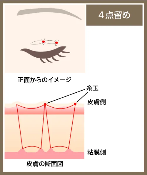 二重整形_埋没法4点留め