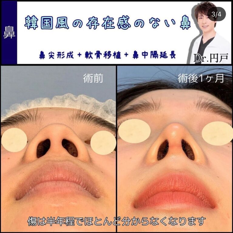 鼻柱形成とは?種類や施術前に知っておきたいポイントを徹底解説|金沢の美容外科はeクリニック