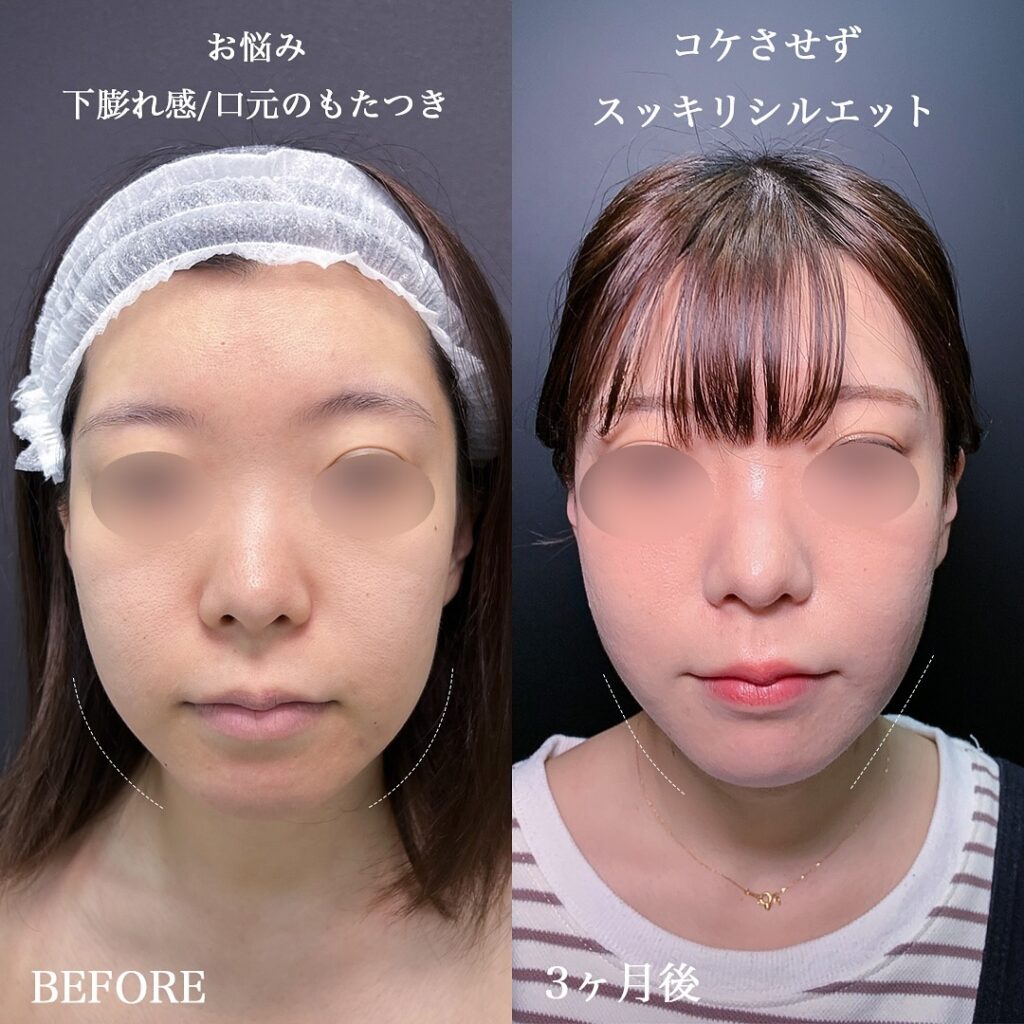 糸リフト(スレッドリフト)は何年持つ？ネットの口コミで多いみんなの感想は？｜金沢の美容外科はeクリニック