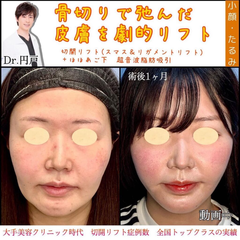 フェイスリフトとほほ、顎下の脂肪吸引の症例写真 (2)