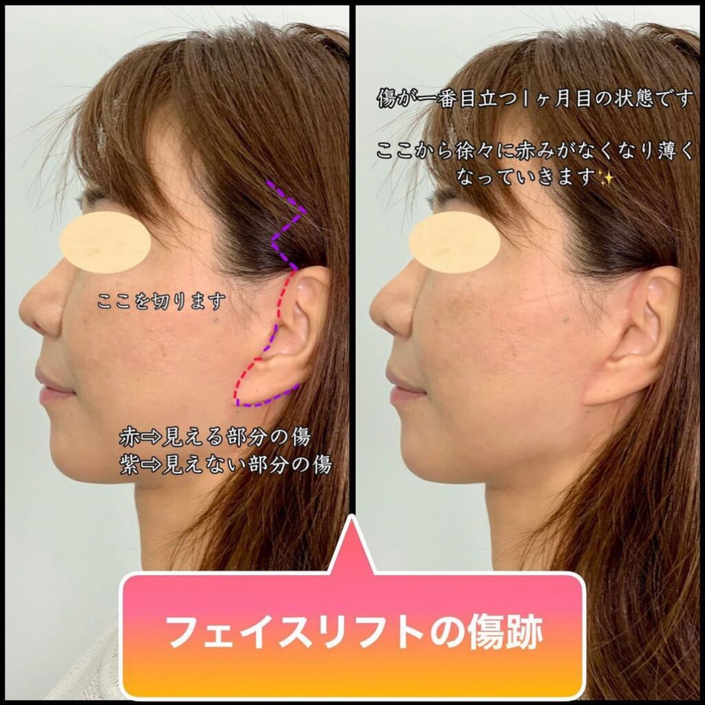 フェイスリフトの傷跡