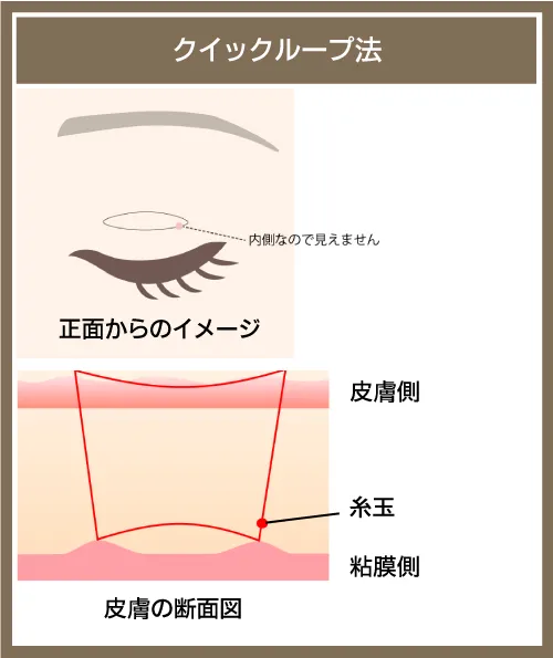 二重整形_埋没法クイックループ法