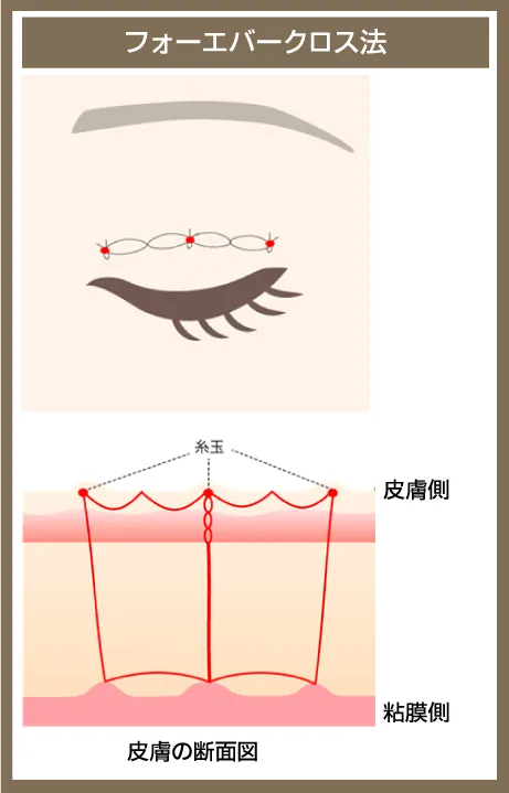 二重整形_埋没法フォーエバークロス法