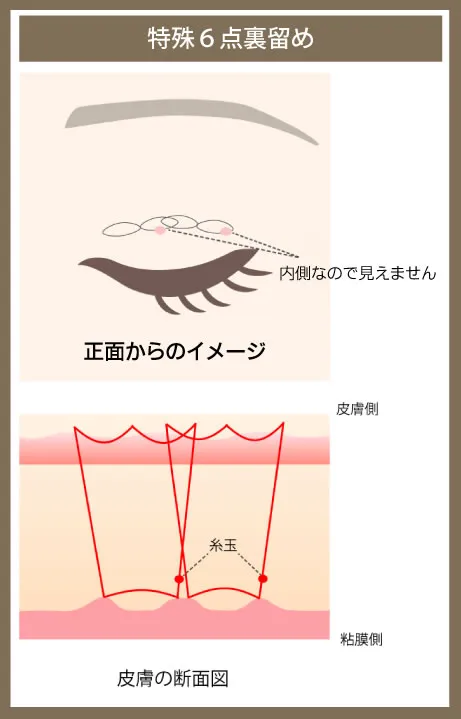 二重整形_埋没法特殊6点留め