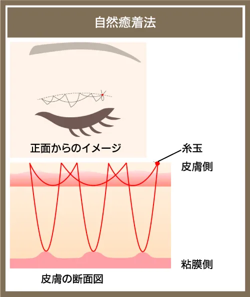 二重整形_自然癒着法