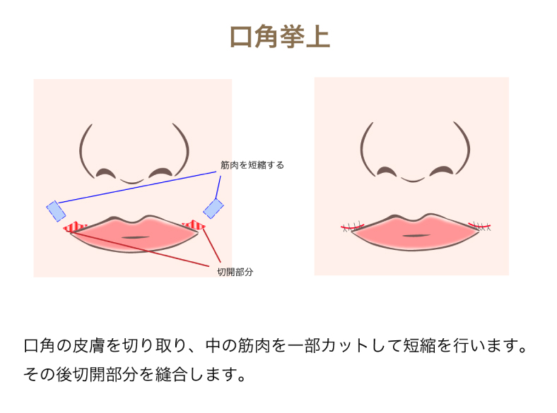 口角挙上の図解